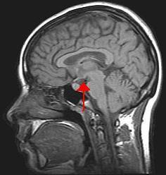 Hypothalamus